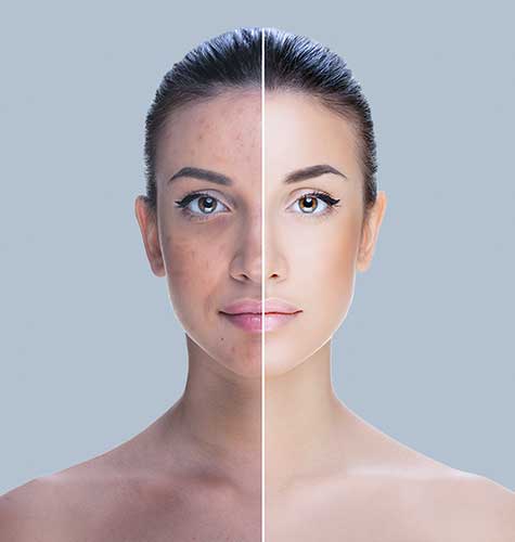 Pigment Treatment